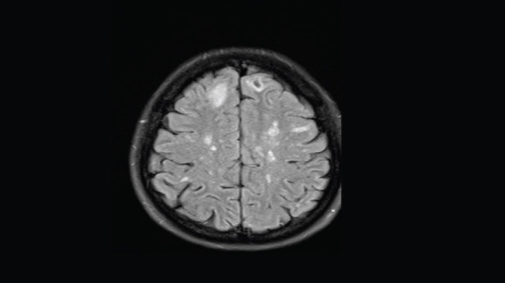 MRI brain scan showing MS lesions